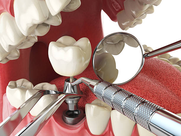 Best Emergency Tooth Extraction in Lakeland South, WA